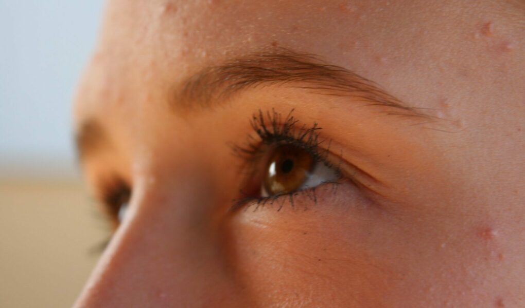 Gros plan sur l'oeil d'une femme adulte et la peau de son visage montrant de petites imperfections, boutons et micro-kystes d'acné sur le front et la joue, illustrant le sujet de l'acné tardive et le besoin de soins doux.