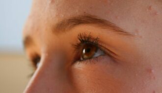 Gros plan sur l'oeil d'une femme adulte et la peau de son visage montrant de petites imperfections, boutons et micro-kystes d'acné sur le front et la joue, illustrant le sujet de l'acné tardive et le besoin de soins doux.